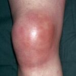 Upper & Lower limb deformity Correction in Vadodara