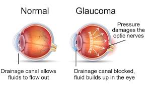 Glaucoma Specialist
