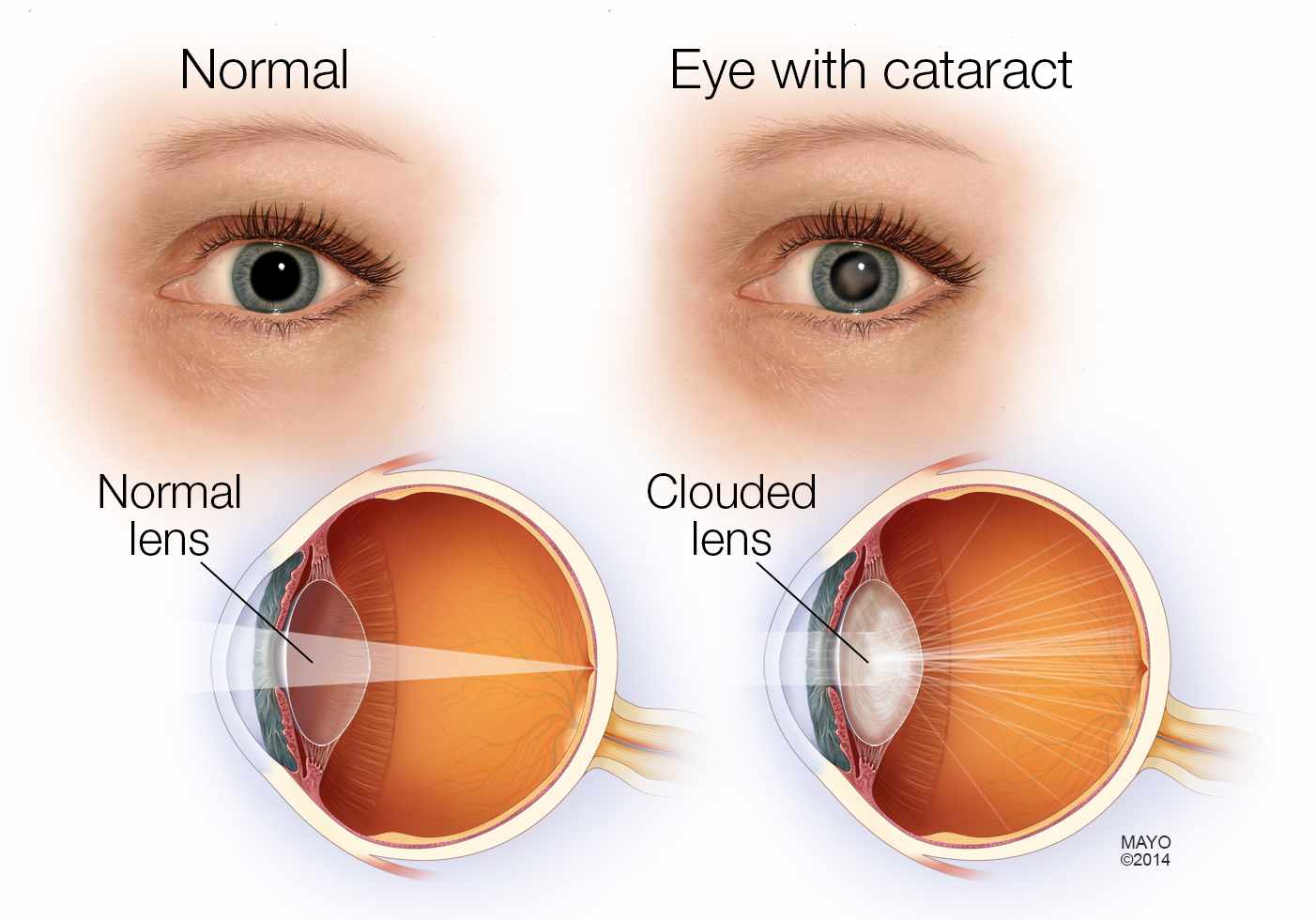 Cataract Surgeon 